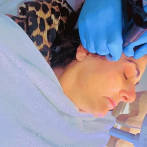 Microneedling Course